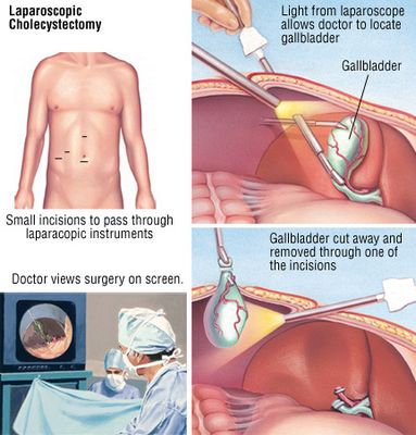 What Happens After gallbladder Removal