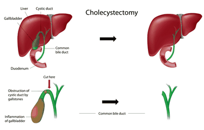 What Happens After gallbladder Removal